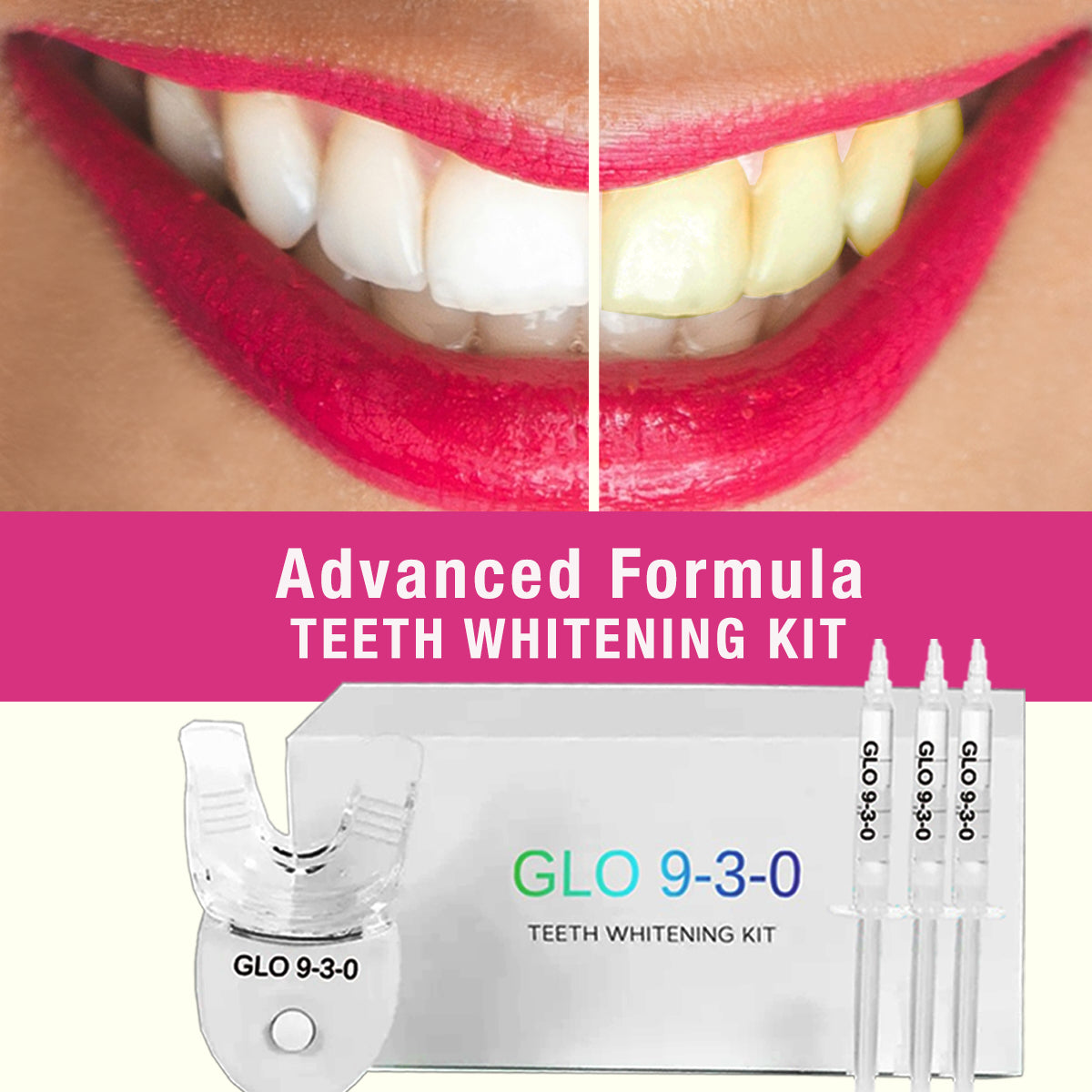GLO 9-3-0 Teeth Whitening Kit
